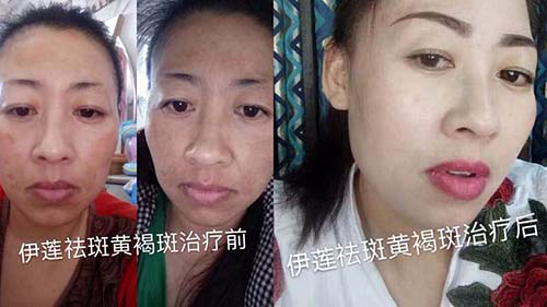 純中藥祛斑代理加盟招商